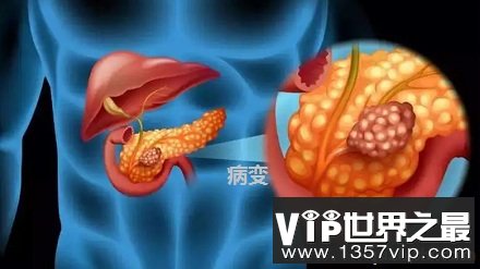 哪些人群最容易患胰腺癌？